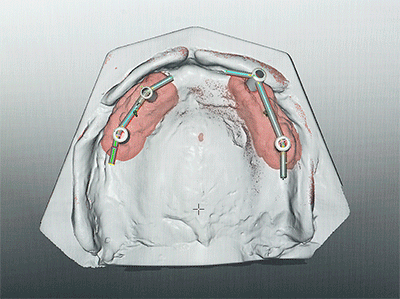 de Gebittenmaker: Afbeelding 3D en gipsmodel implantaten